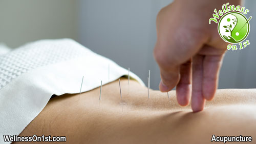 Acupuncture Calgary